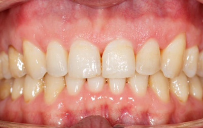 Resultat vue de face apres-traitement par appareil dentaire fixe