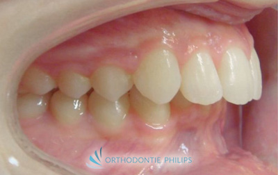 Vue de profil droit de l'alignement des dents avant traitement 