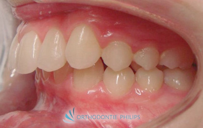 Vue de profil gauche de l'alignement des dents avant traitement