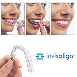 invisalign devis prix tarif