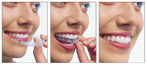 Gouttières transparentes Invisalign